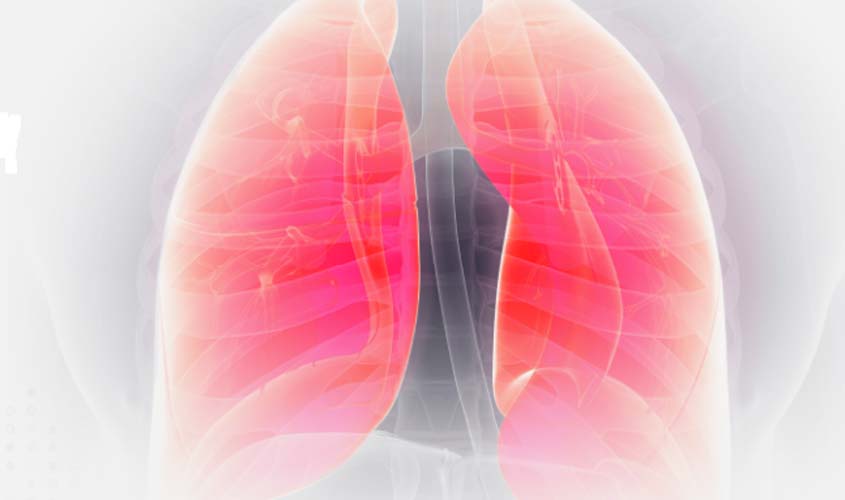 Avanços no câncer de pulmão marcam a ASCO 2026