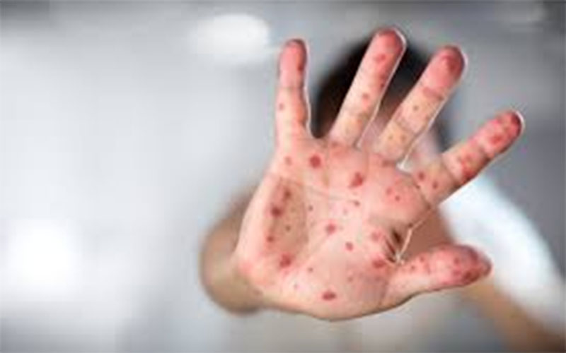 Sarampo: entenda os sintomas, riscos e tratamento