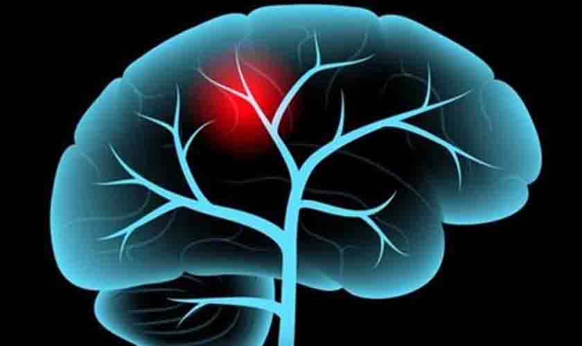 Neurologista Alerta Sobre Aumento De Casos De AVC Em Jovens