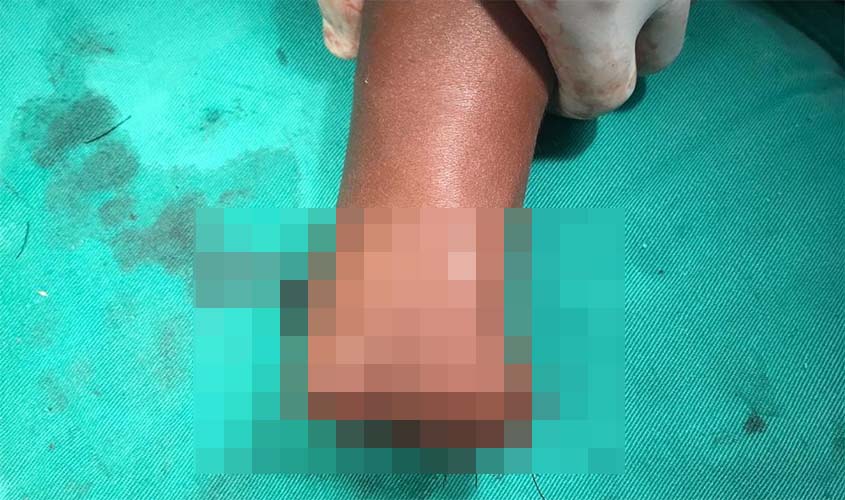 Em Porto Velho, criança tem mão dilacerada e amputada após bombinha estourar 