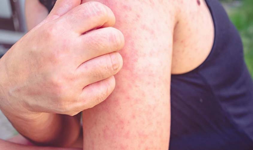 Doenças De Pele Podem Piorar Com O Estresse, Diz Pesquisa