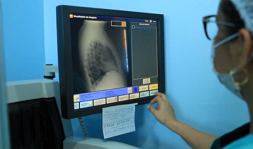 Ações alertam sobre cuidados com tuberculose em PVH