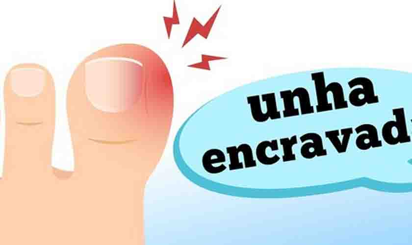 O que causa unha encravada?