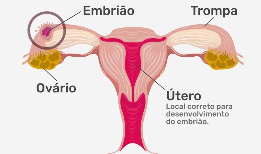 Gravidez ectópica: o desenvolvimento silencioso de um embrião fora do útero