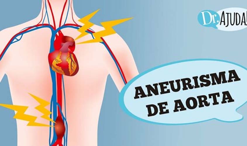 ANEURISMA DE AORTA: O que é, sintomas e tratamento