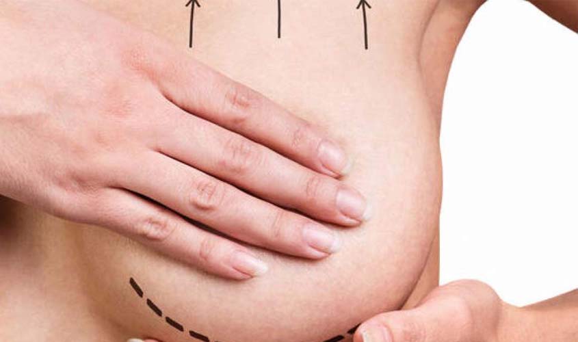 Mastopexia é procedimento mais desejado pós-gravidez