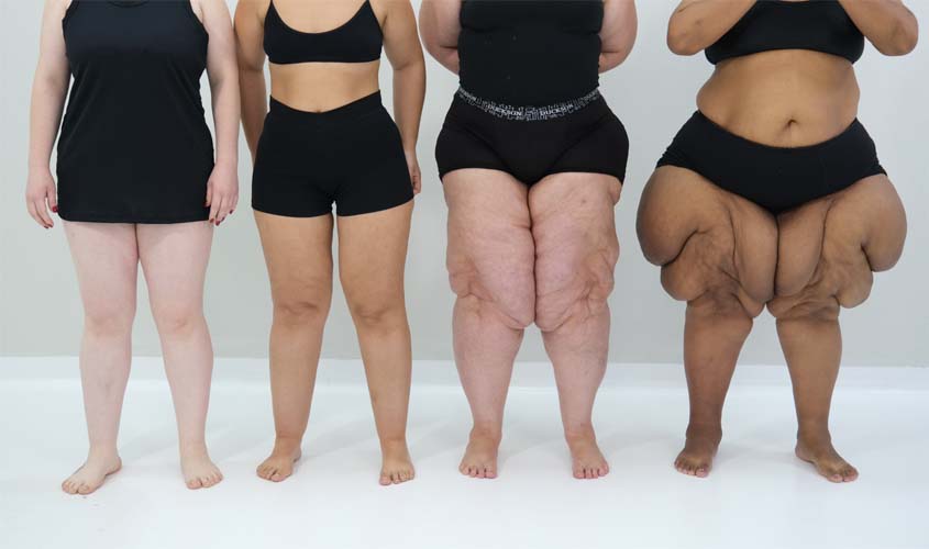 Especialistas esclarecem principais dúvidas sobre o lipedema