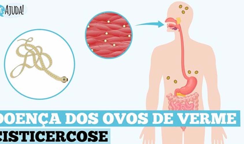 O que é cisticercose? Quais os sintomas e o tratamento?