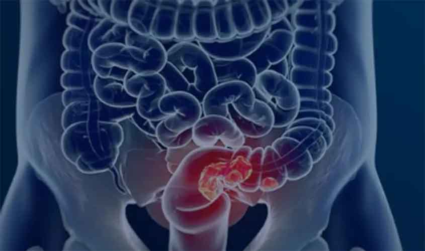 Estudo projeta aumento de 36% em mortes por câncer colorretal até 2040