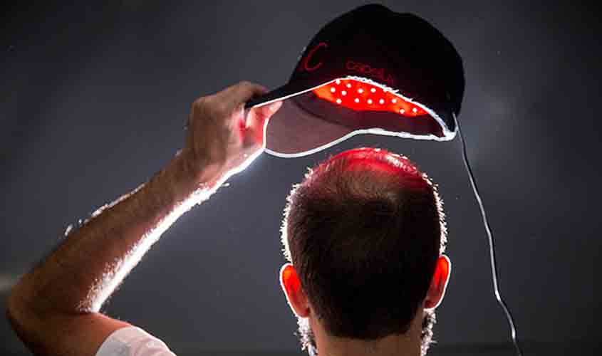 Calvície masculina: sem cura, terapia com LED breca avanço e deve começar cedo