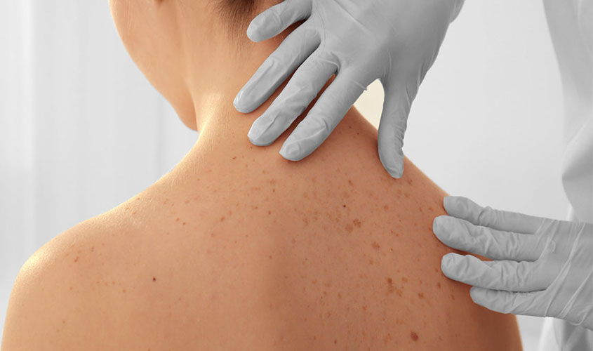 Novos tratamentos contra o câncer da pele