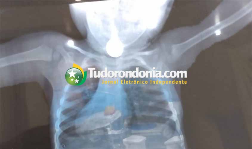 Criança se engasga com moeda de dez centavos