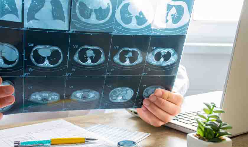 Majorada condenação de indústria por morte de auxiliar por asbestose