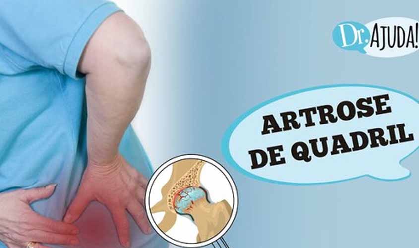 ARTROSE DE QUADRIL: Quando suspeitar? Como tratar?