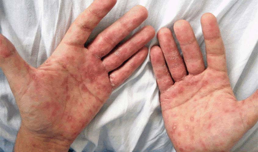 Semusa realiza atividades em alusão ao Dia Nacional de Combate à Sífilis