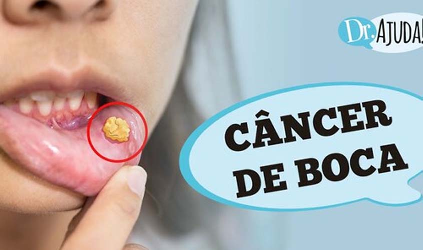 CÂNCER DE BOCA: o que é, sintomas e tratamento