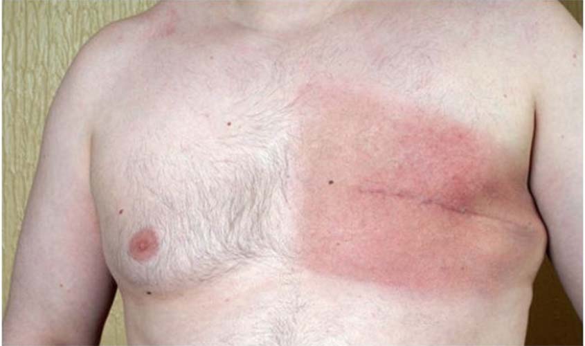 Homens representam 1% do total de casos de câncer de mama no Brasil