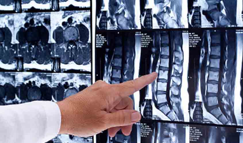 Negado pedido de indenização por lesão em coluna de origem degenerativa