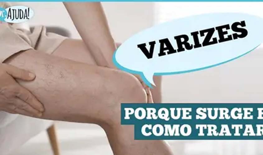 Varizes: não é só estética é saúde vascular