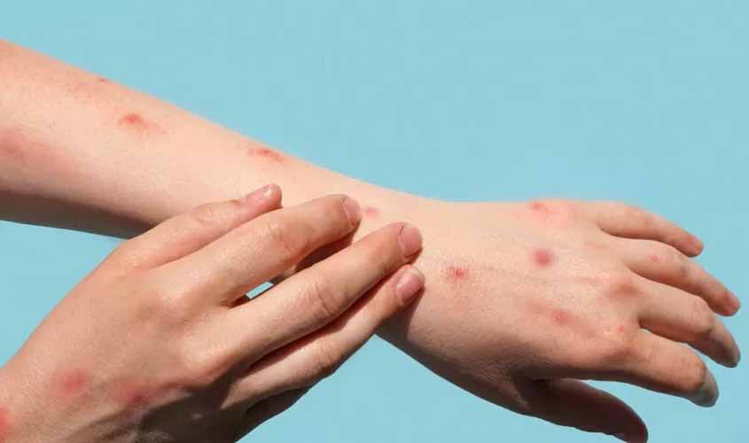 Brasil confirma terceiro caso de varíola dos macacos; conheça sintomas e cuidados