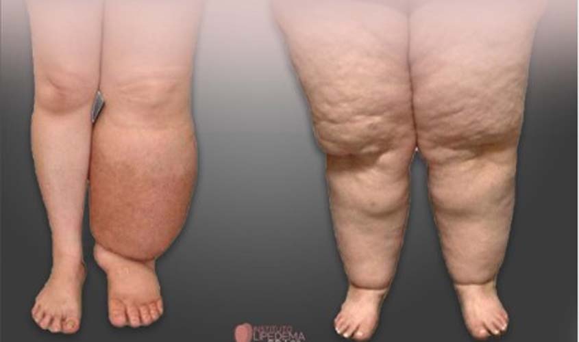 'Como saber se é lipedema e não uma gordura localizada?'