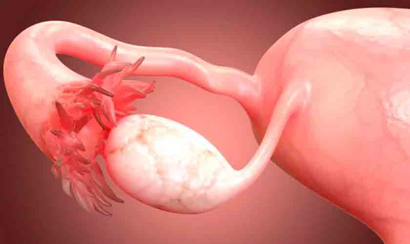 Agência Brasil explica: sintomas e tratamentos do câncer de ovário
