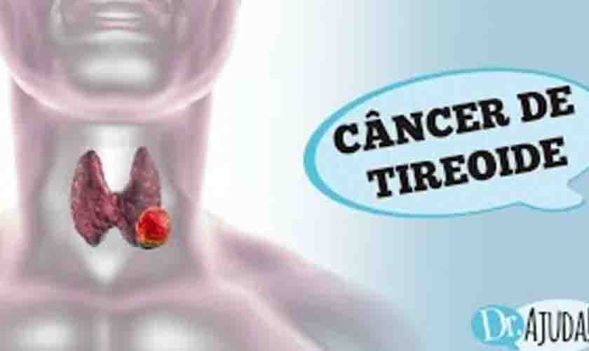 Nódulo de tireoide: como identificar?