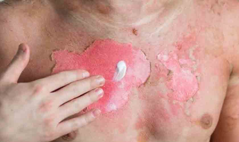 Aumento no preço do gás de cozinha eleva número de acidentes com álcool