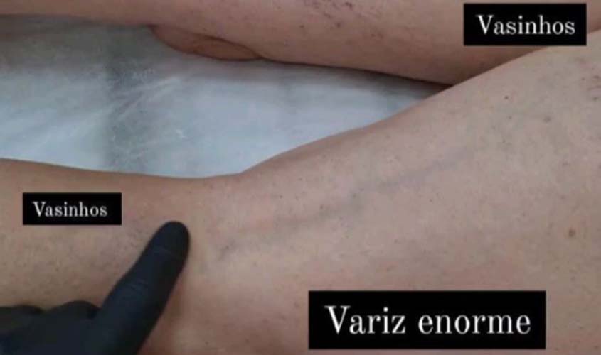 Varizes não tratadas podem levar a sérios problemas de saúde