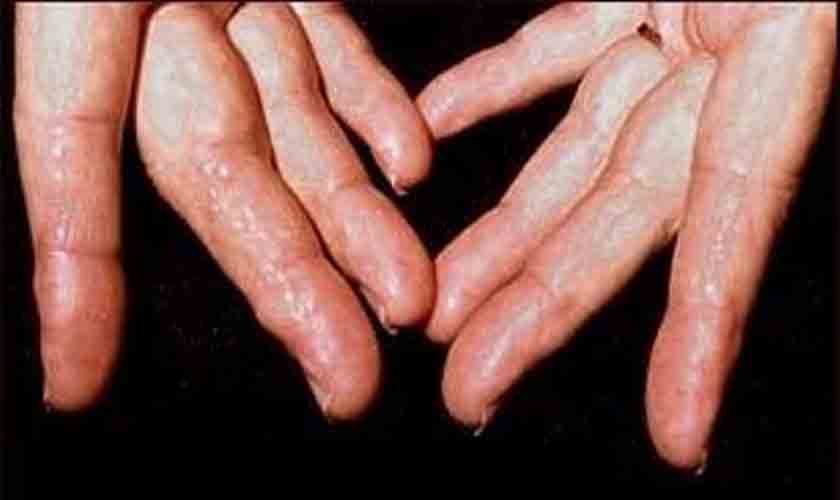 Dia da Amiloidose Hereditária marca dificuldade de acesso a novas terapias