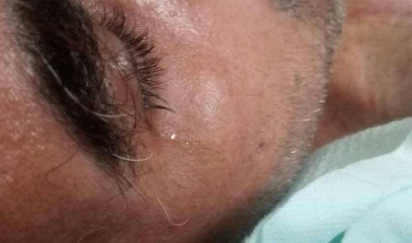 Internado há seis meses e implorando por cirurgia, morador de Colorado do Oeste está ficando com o corpo 'em carne viva'