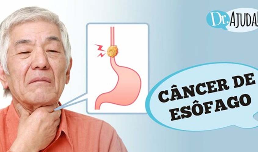 Câncer de Esôfago: quais os sintomas e o tratamento?