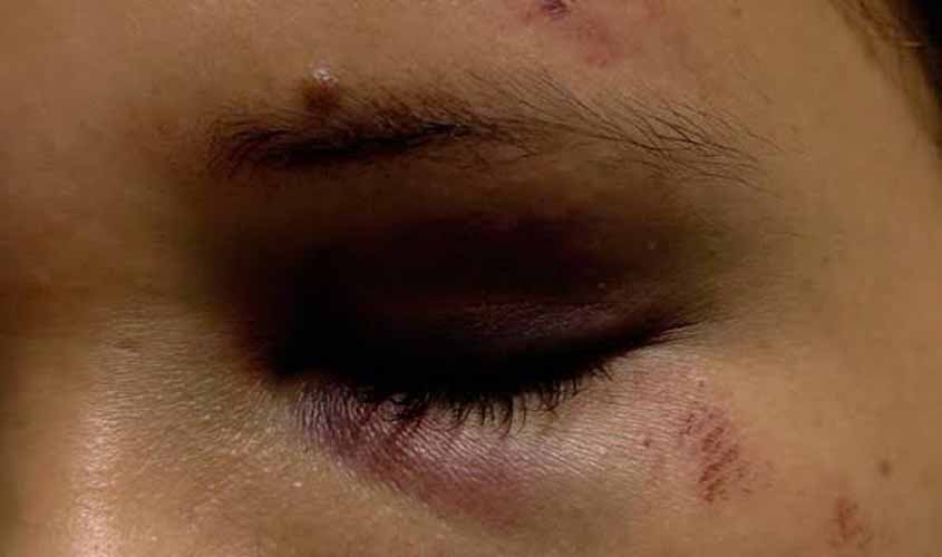 Durante bebedeira,  homem agride irmã com soco no rosto