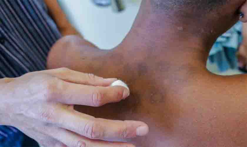 Fiocruz participa de campanha global Não Esqueça da Hanseníase