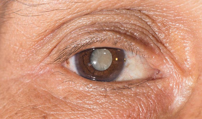 Cirurgias de catarata: saiba como agendar sua consulta para ser beneficiado