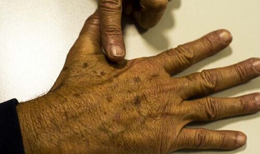 Câncer de pele é o mais comum no Brasil; saiba como evitar