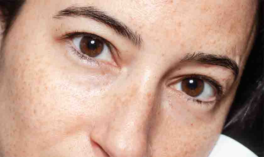 Tratamentos possíveis para a hiperpigmentação pós-inflamatória