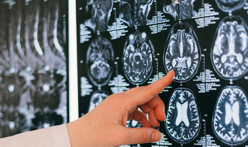 O que fazer após o diagnóstico de esclerose múltipla?