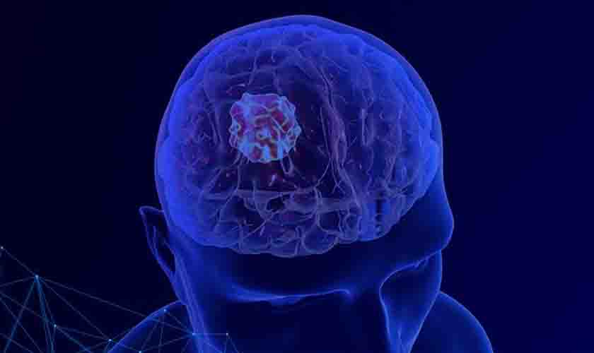 É possível viver bem após um tumor cerebral? Neurocirurgião da UNICAMP explica