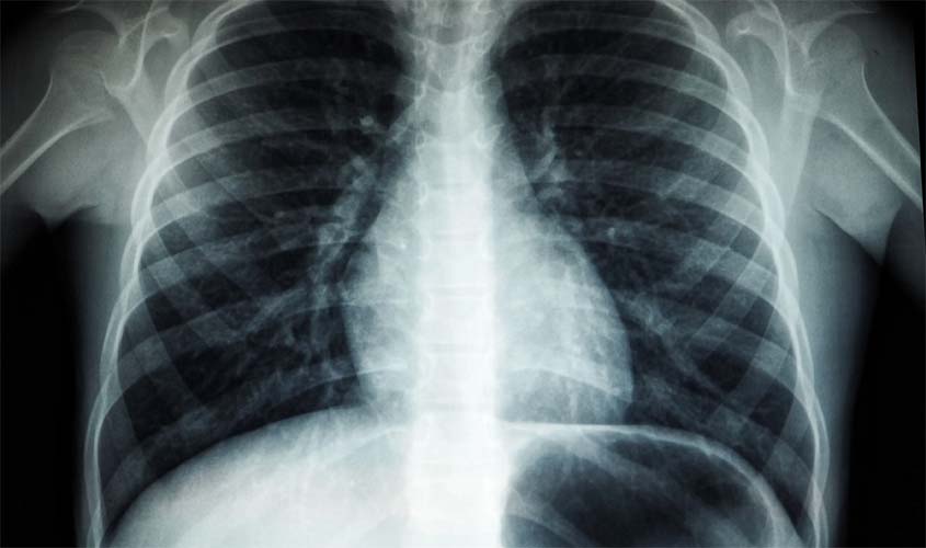 10 fatos para você entender a tuberculose