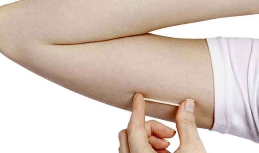 Prefeitura oferece Implanon gratuito a mulheres de 14 a 49 anos