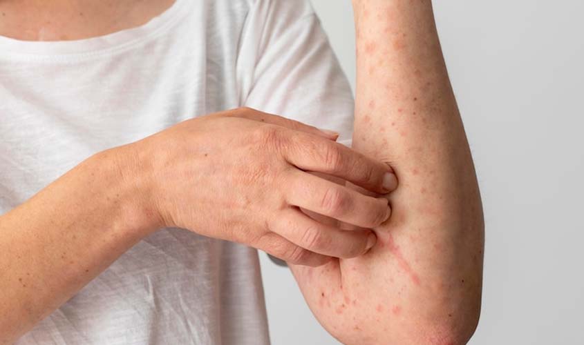 Saiba mais sobre a zoonose viral monkeypox