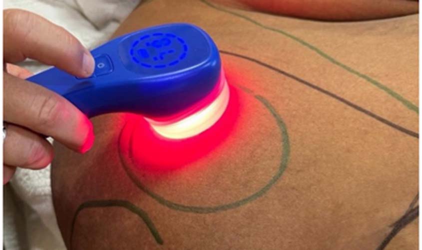 Fotobiomodulação: o que é e como atua no lipedema