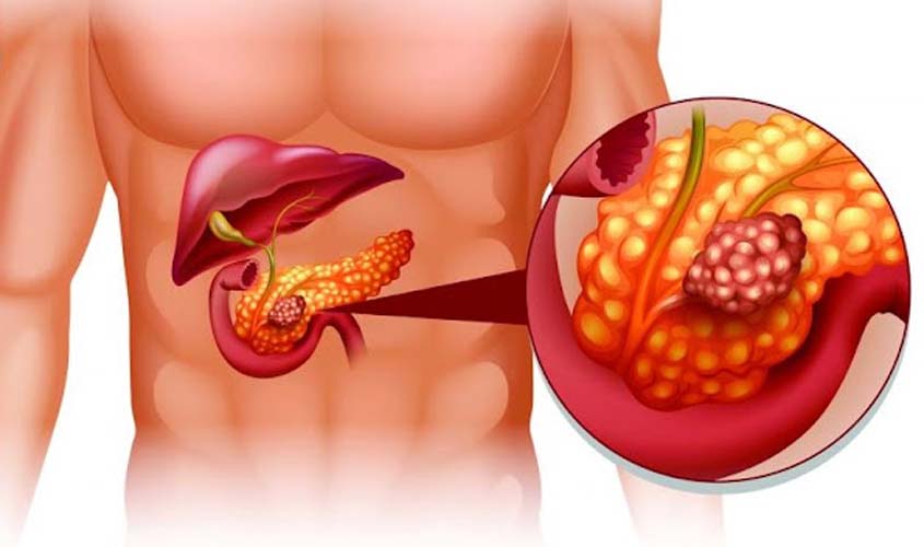 Câncer de pâncreas: estudo traz novidades sobre prevenção para um dos tumores mais agressivos 