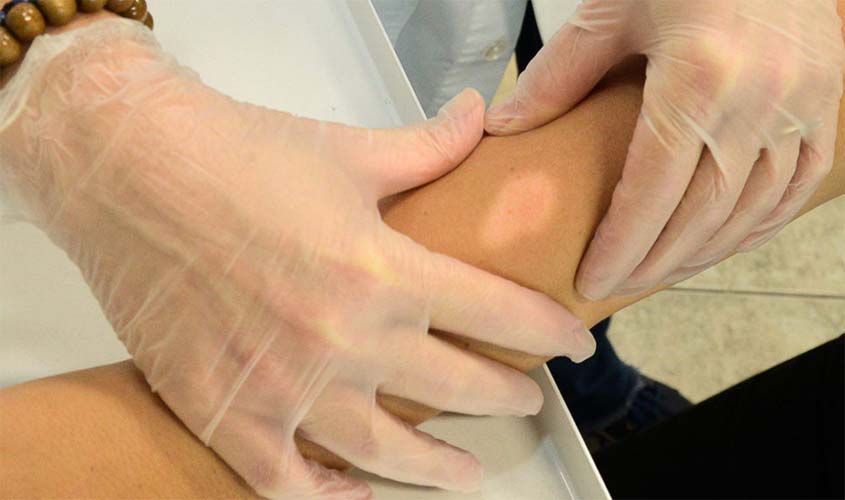 Prefeitura realizará ação para o diagnóstico precoce da Hanseníase; atendimentos serão nos dias 26 e 31 de janeiro