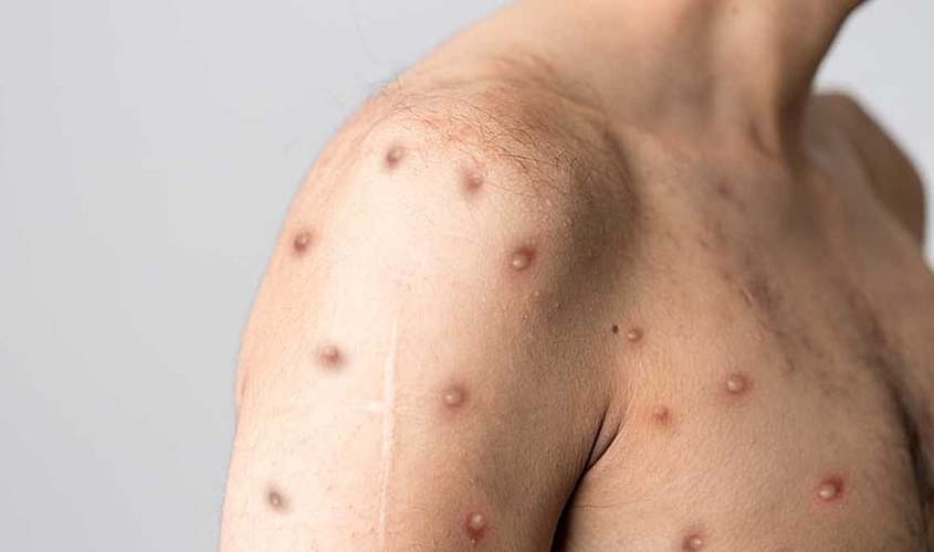 Prefeitura orienta população em casos de suspeita de Mpox