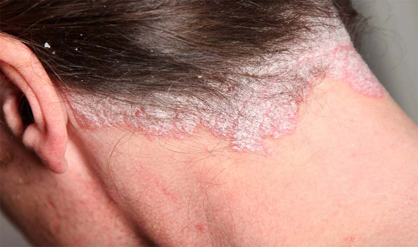 Mantida condenação de médico que prometeu cura para psoríase