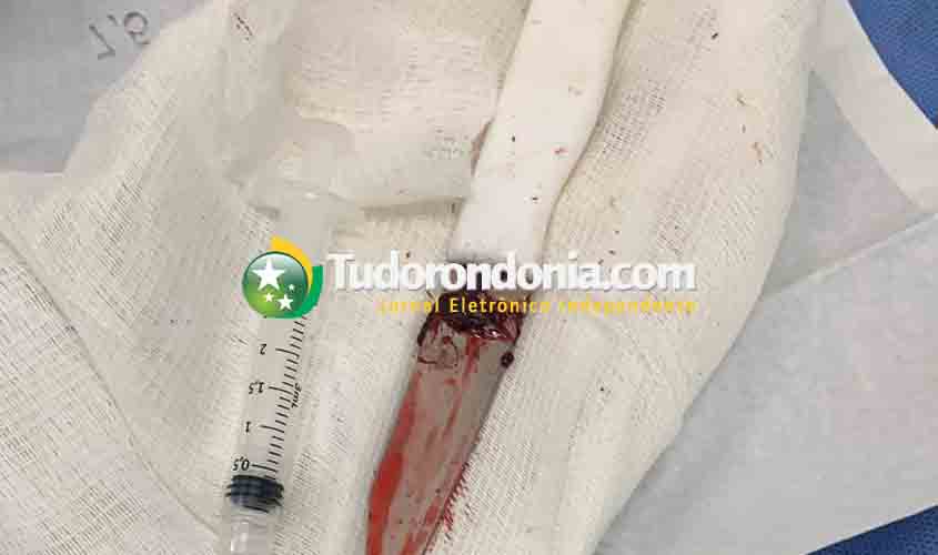 Homem tem faca cravada na barriga durante briga em Candeias do Jamari