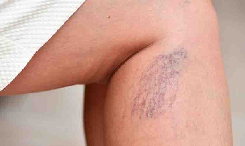 Por Que As Varizes Surgem E Como Prevenir?