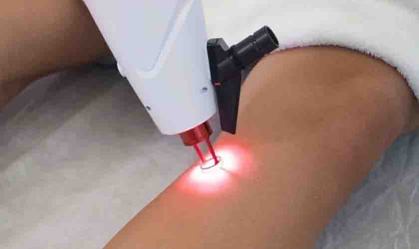 Tratamento De Vasinhos Com Laser Transdérmico